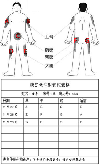 打胰岛素位置图 手臂图片